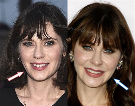 zooey deschanel facelift|Zooey Deschanel Plastic Surgery Before and After。